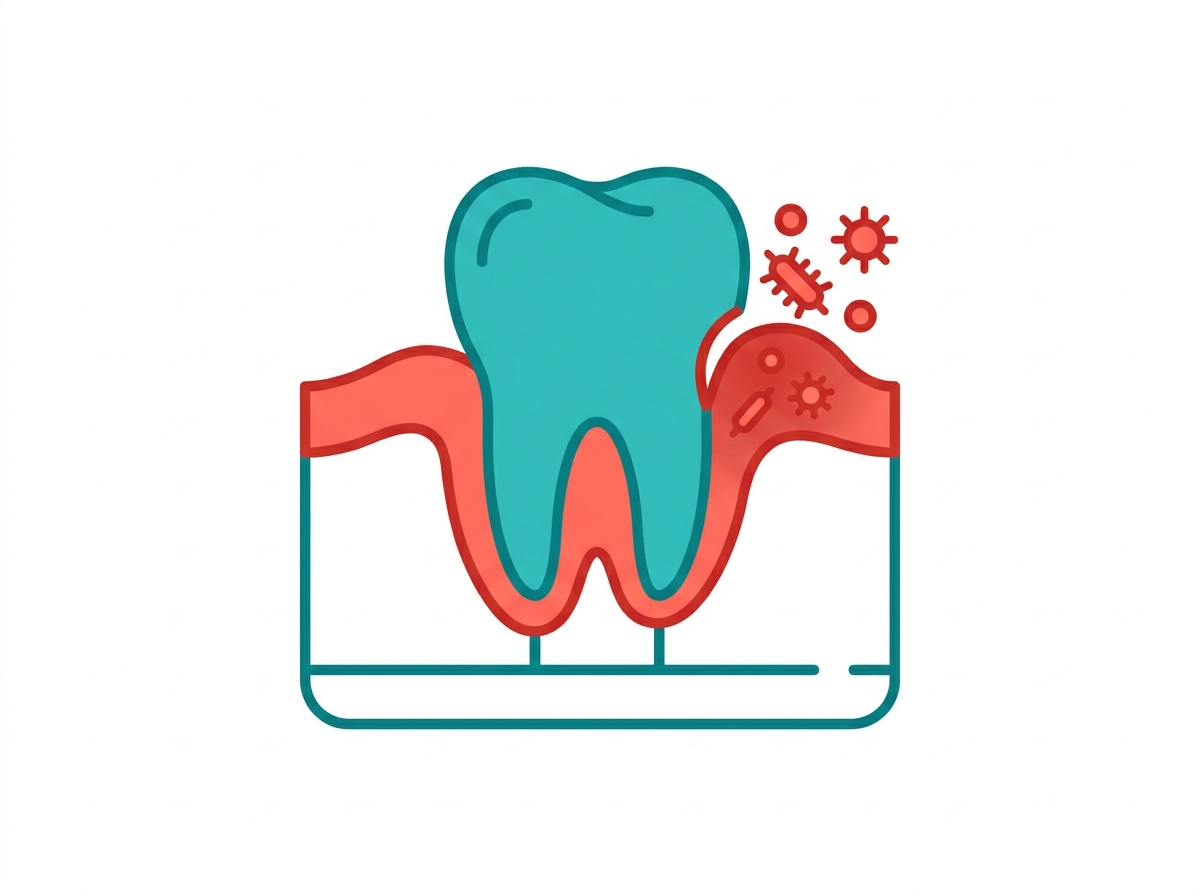 Illustration of pericoronitis — inflamed gum tissue around a partially erupted wisdom tooth